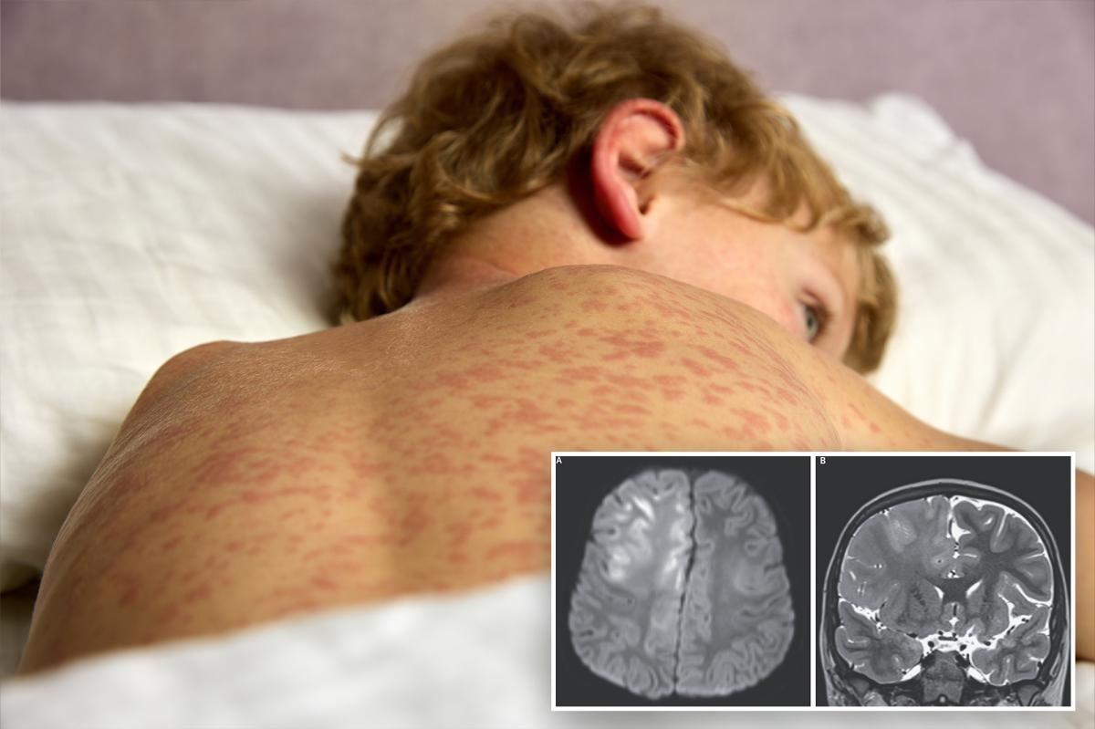 Boy, 7, dies of brain condition caused by measles — years later