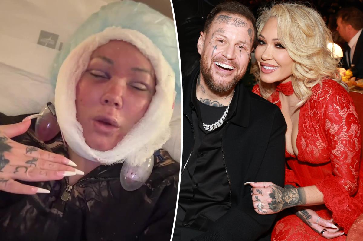 Jelly Roll's wife, Bunnie Xo, unveils gruesome aftermath of facelift