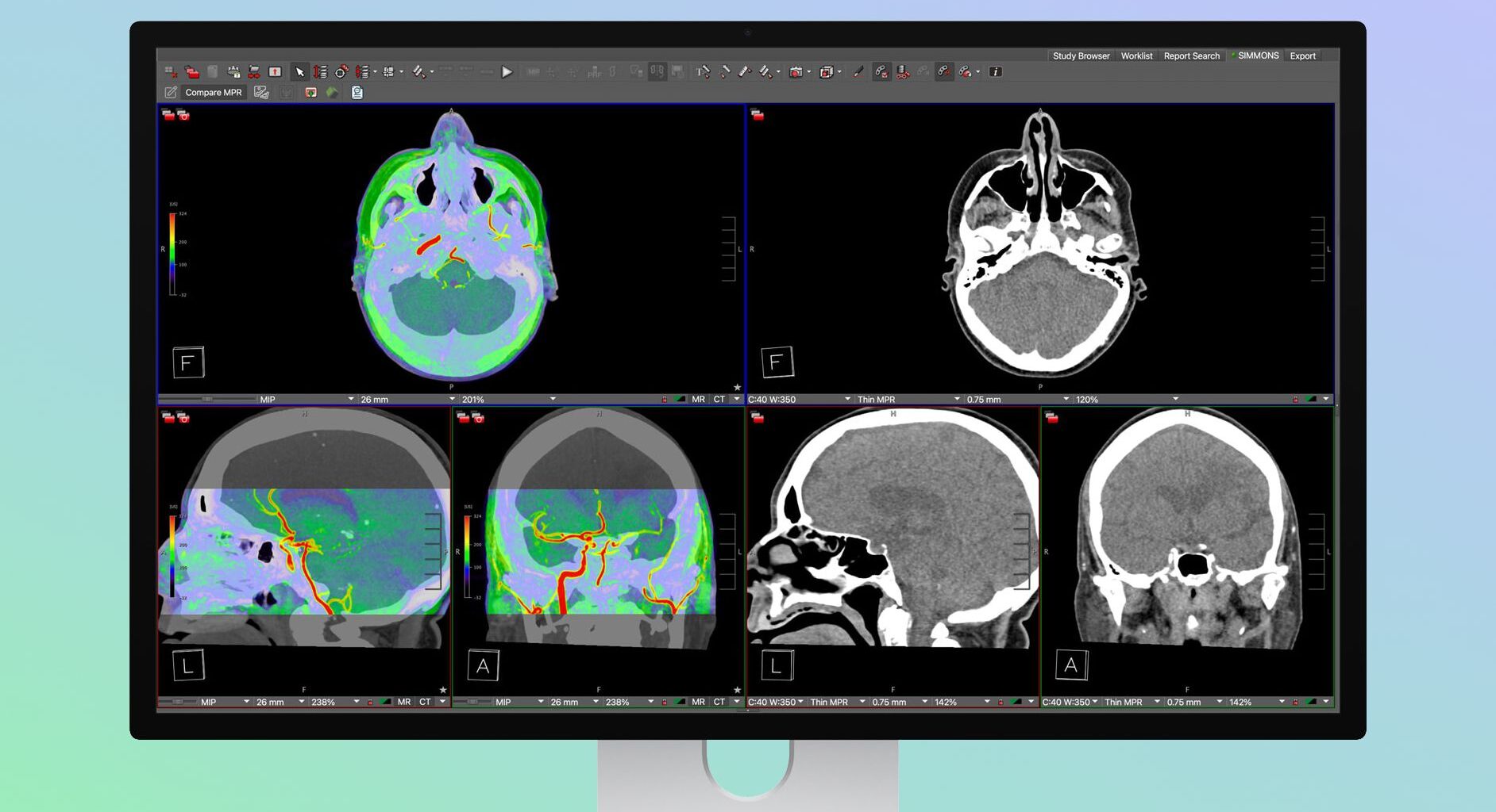 Apple's Studio Display XDR Supports DICOM Medical Imaging for Diagnostic Radiology