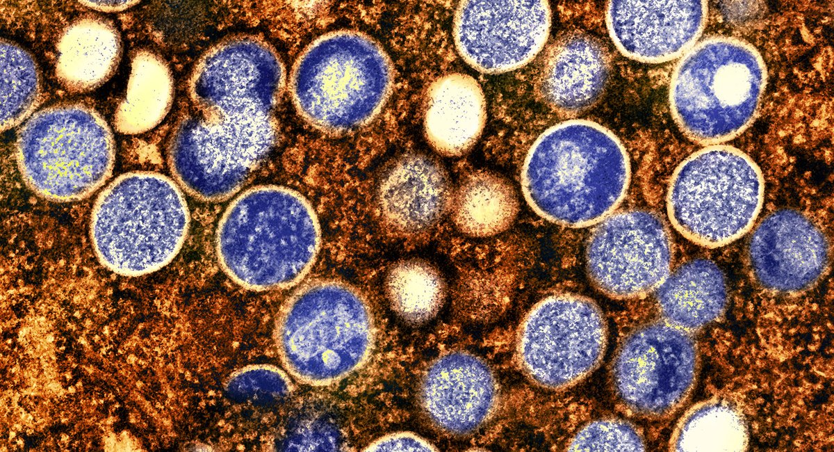 What to know about NYC's first case of severe mpox strain