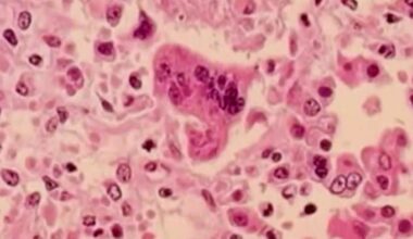 Michigan health officials urge vaccinations after measles outbreak hits Washtenaw County