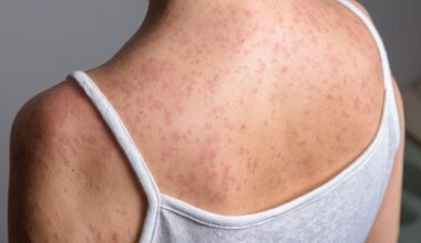 Salem health care centers identified as latest measles exposure sites