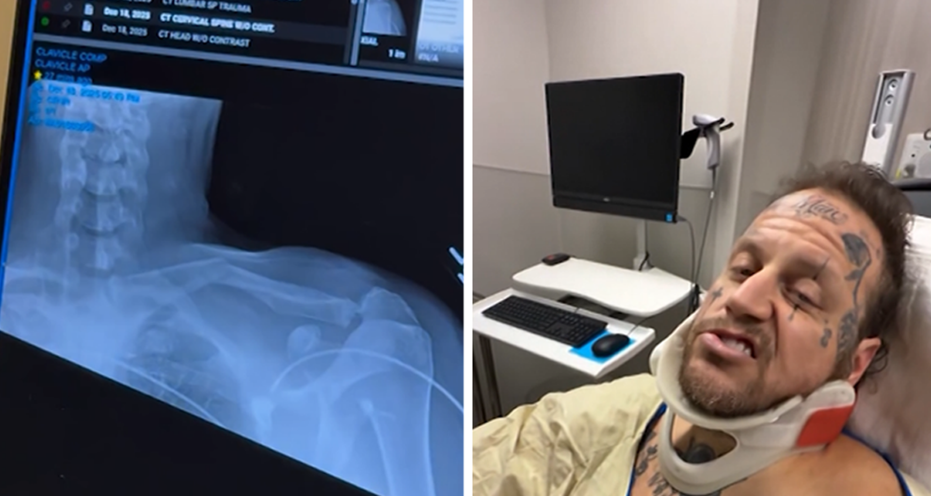 Jelly Roll Was at Grammys With a Broken Collarbone From ATV Crash, Bunnie Posts Vid