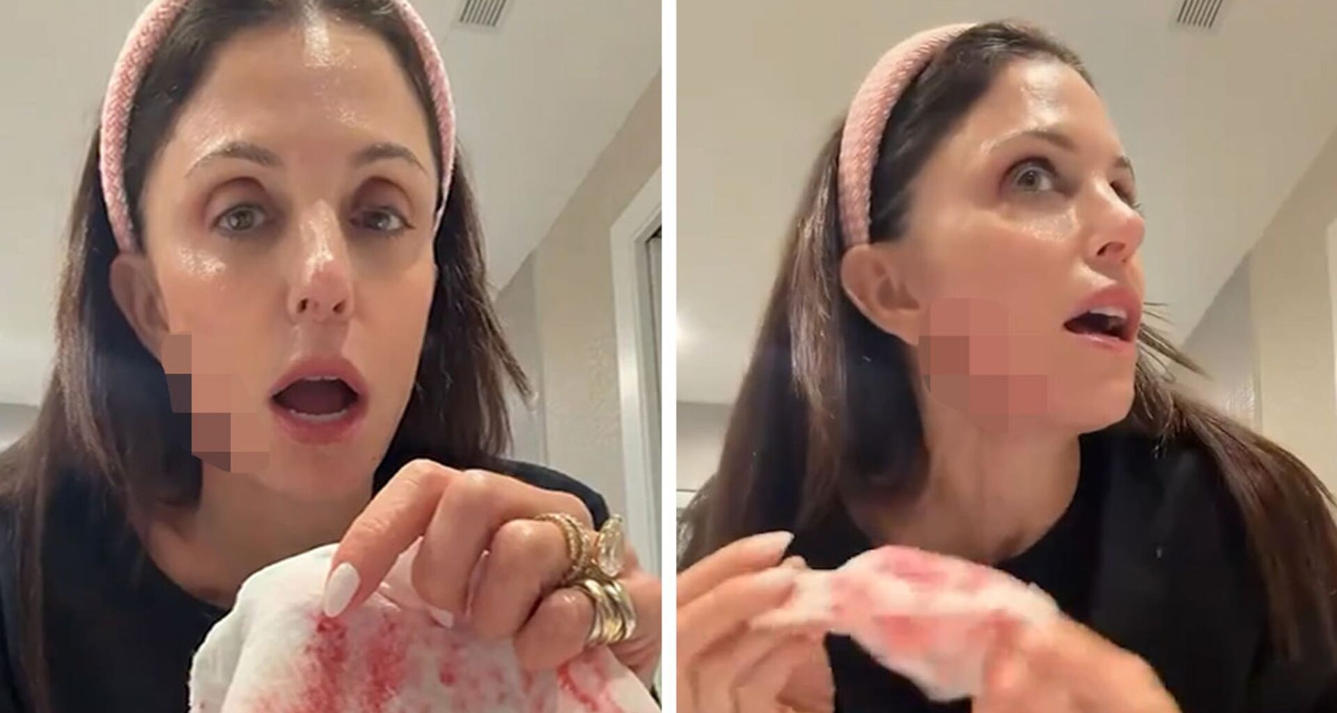 Bethenny Frankel Bleeds After Cutting Her Face With Skin Product on Video