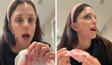 Bethenny Frankel Bleeds After Cutting Her Face With Skin Product on Video