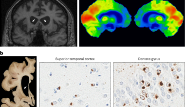 A repeat expansion in GOLGA8A is a major risk factor for atypical frontotemporal lobar degeneration with ubiquitin-positive inclusions