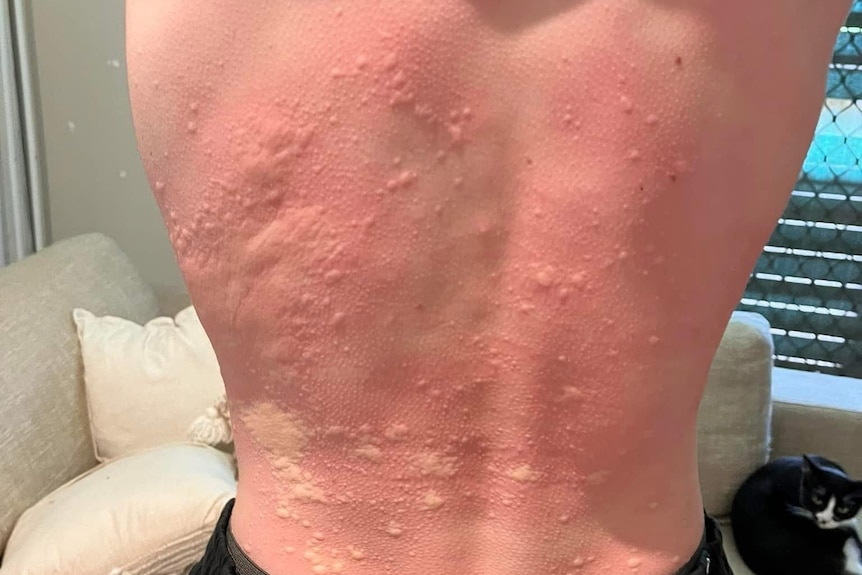 Nasty welts on a young man's back.