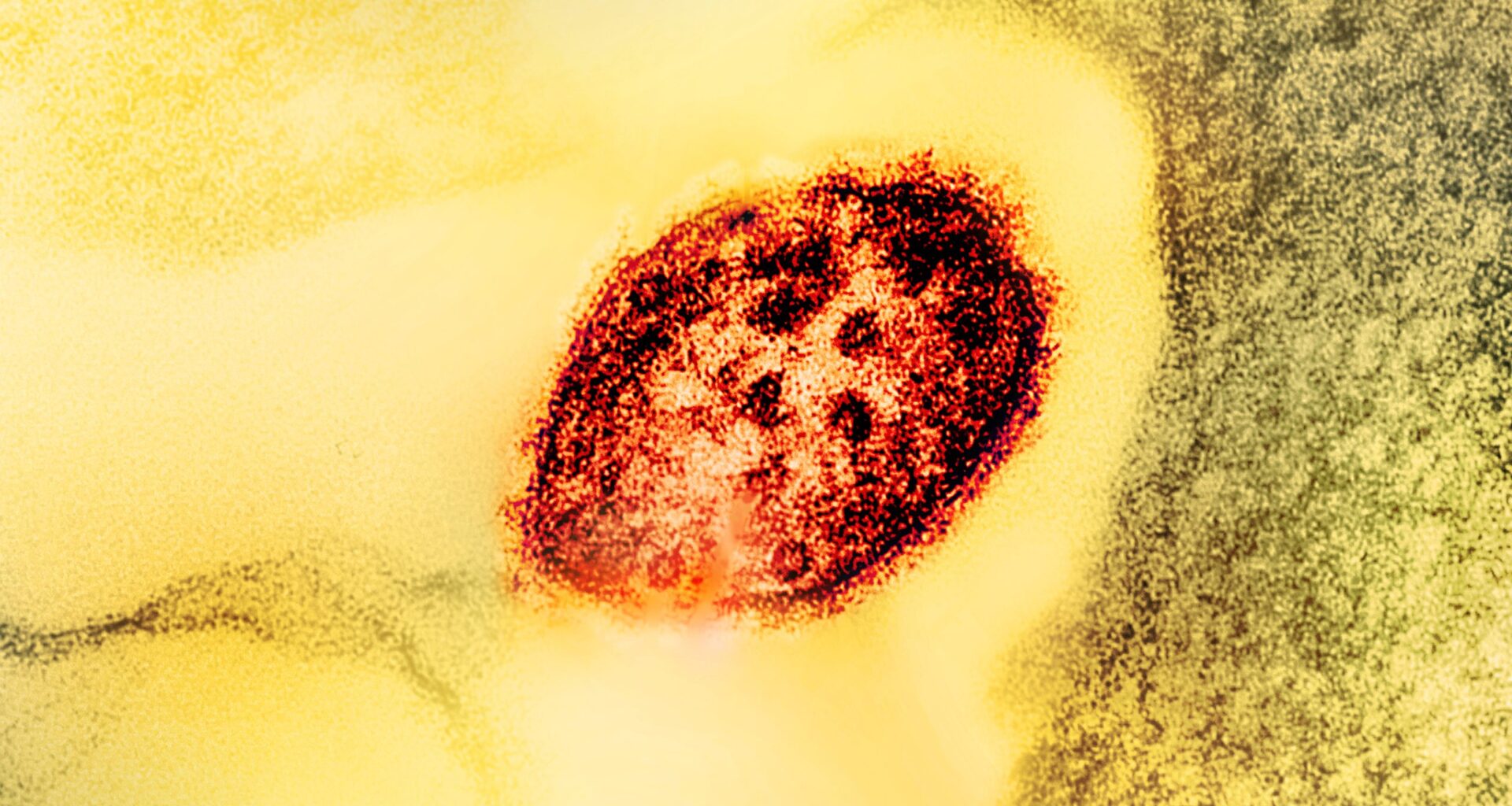 Broomfield measles outbreak now up to as many as 10 cases