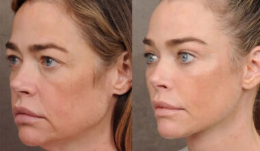 Denise Richards Shares Before-and-After Photos of Shocking Facelift Transformation She Was 'Terrified' to Undergo