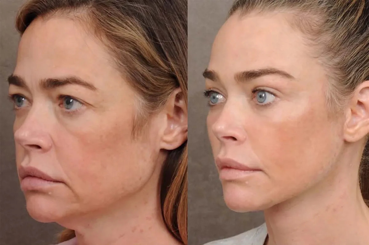 Denise Richards Shares Before-and-After Photos of Shocking Facelift Transformation She Was 'Terrified' to Undergo