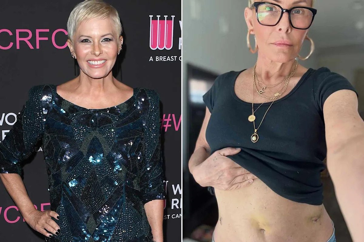 Nicole Eggert Shows Hysterectomy Scars After Doctors Found 'Signs of More Cancer'