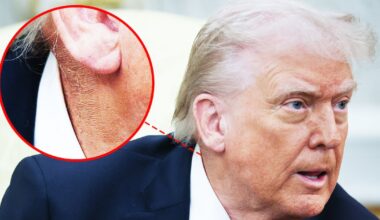 Donald Trump, 79, Uses Favorite Fix to Battle New Health Problem