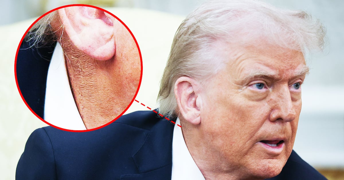 Donald Trump, 79, Uses Favorite Fix to Battle New Health Problem