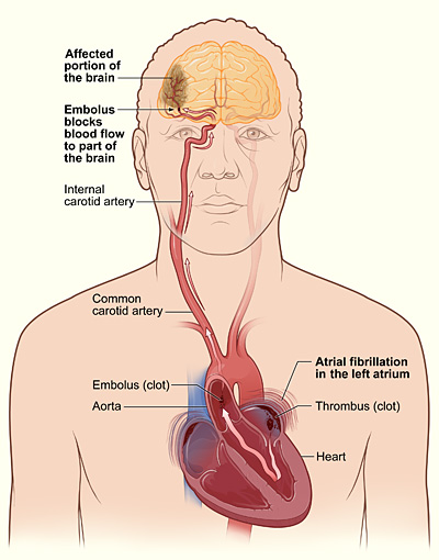  The illustration shows how a stroke can occur during atrial fibrillation. A blood clot (thrombus) can form in the left atrium of the heart. If a piece of the clot breaks off and travels to an artery in the brain, it can block blood flow through the artery. The lack of blood flow to the portion of the brain fed by the artery causes a stroke.