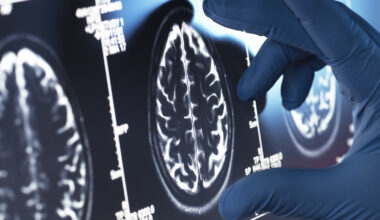 Viagra May Be One of Our Best Existing Options For an Alzheimer's Treatment : ScienceAlert