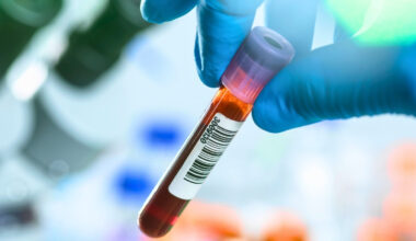 Blood Tests Could Revolutionize Early Cancer Detection – But There's a Catch : ScienceAlert