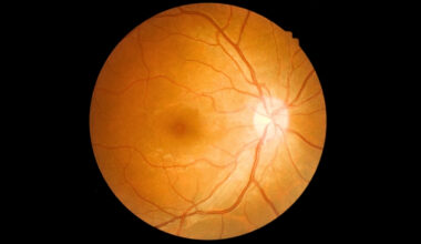 What Is 'Eye Stroke'? Expert Explains The Rare Wegovy Risk : ScienceAlert