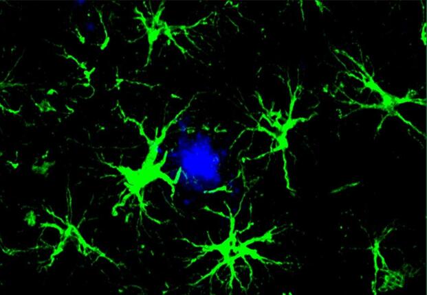 As VA Looks Ahead to Dementia Needs, Study Finds Immune Cells Attack Alzheimer’s Plaques in Brain