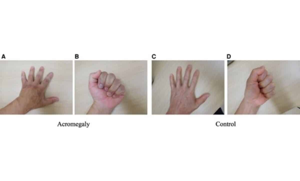 Acromegaly Vs. Control Ai Training Images Of Dorsal Hand And Clenched Fist Postures ©the Journal Of Clinical Endocrinology And Metabolism.