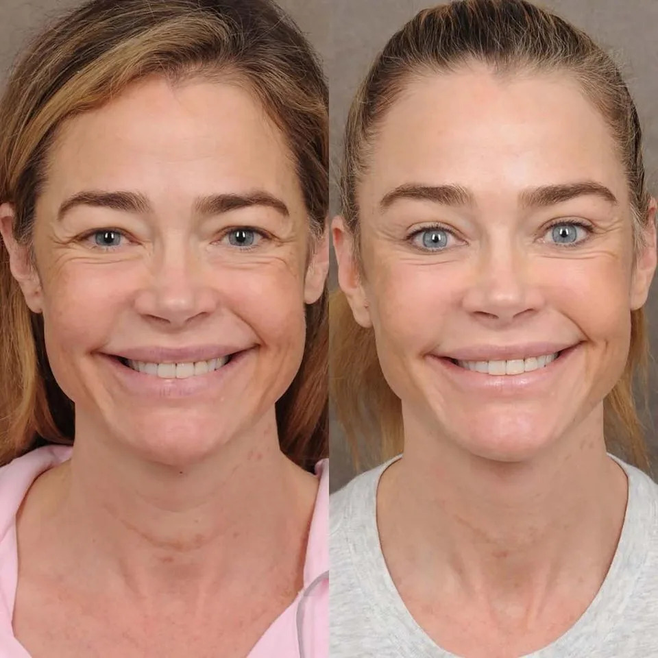 Denise Richards' facelift resultsCredit: Ben Talei, MD/Instagram
