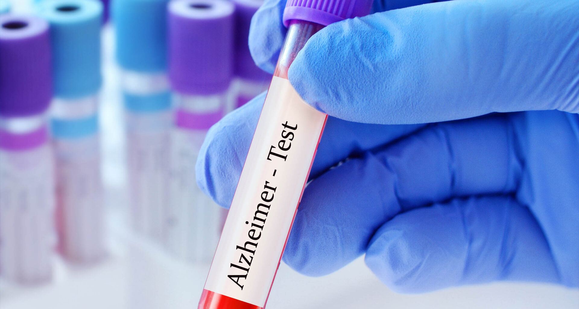 Blood test predicts dementia 25 years before symptoms appear