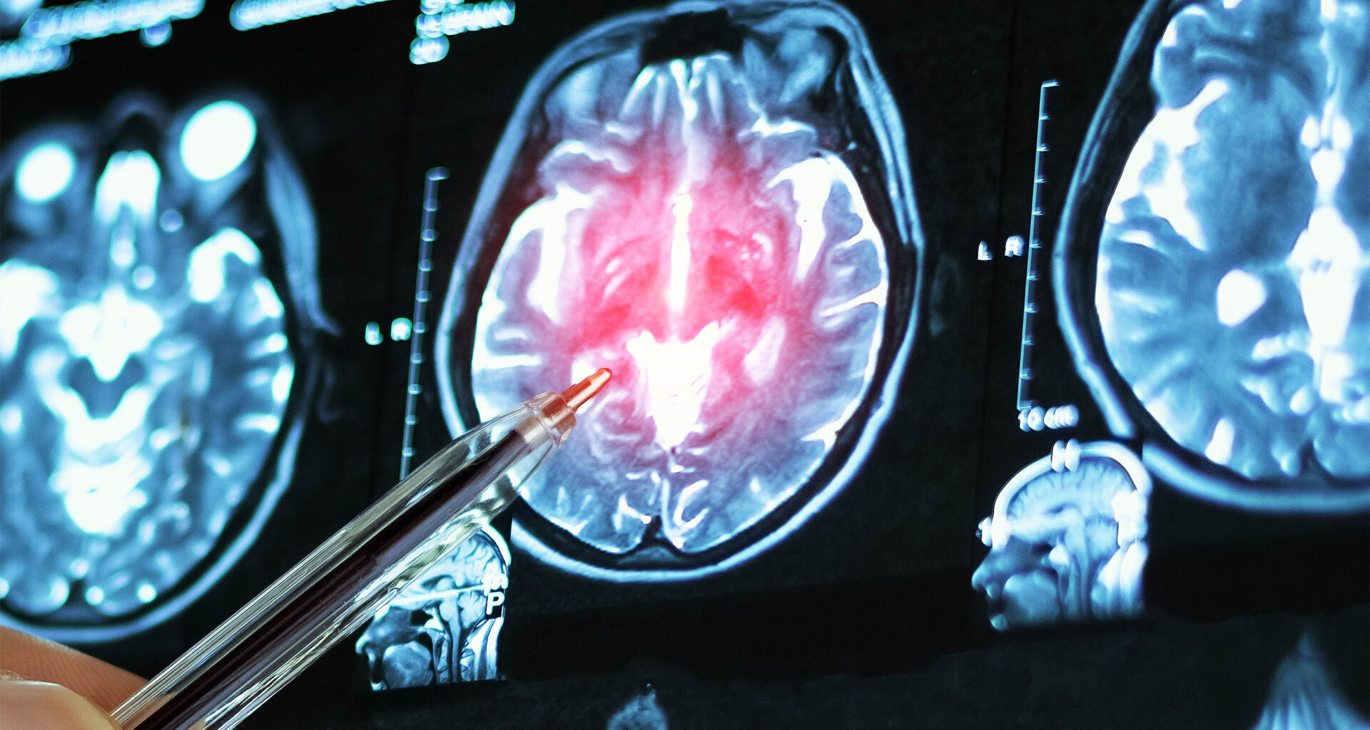 Experimental drug restores memory loss caused by Alzheimer's