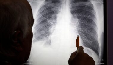 Silicosis, lung disease once linked to mining, hits workers in countertops industry