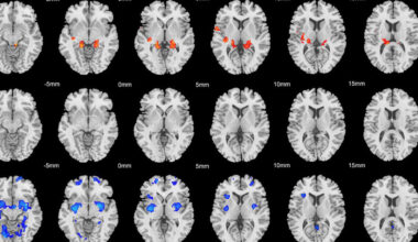 Brain scans reveal two distinct physical subtypes of ADHD
