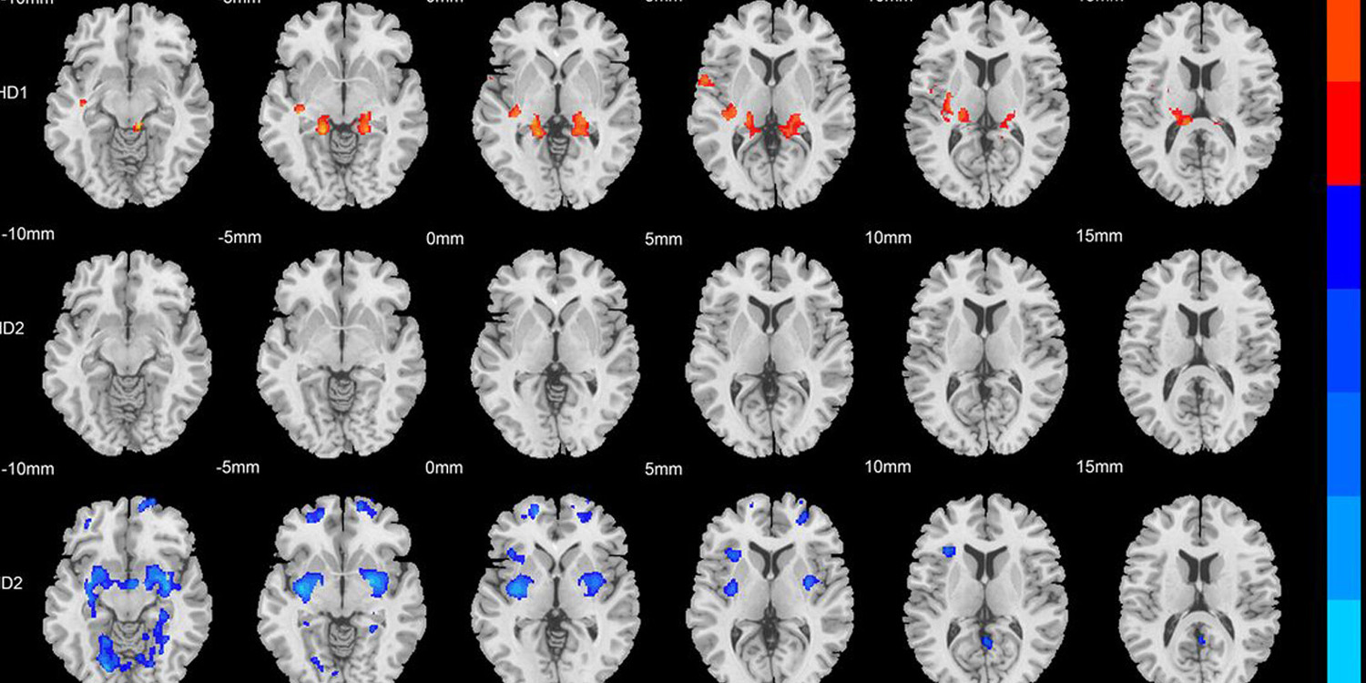 Brain scans reveal two distinct physical subtypes of ADHD