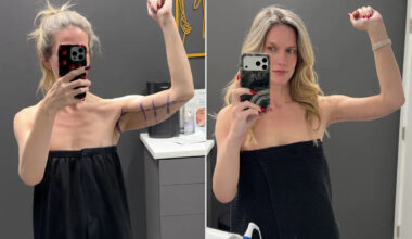 Woman, 41, Was Tired of 'Hiding' Excess Skin After Losing 180 Lbs. on a GLP-1. Then She Got an 'Awake' Arm Lift (Exclusive)