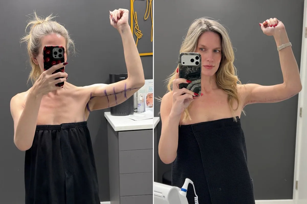 Woman, 41, Was Tired of 'Hiding' Excess Skin After Losing 180 Lbs. on a GLP-1. Then She Got an 'Awake' Arm Lift (Exclusive)
