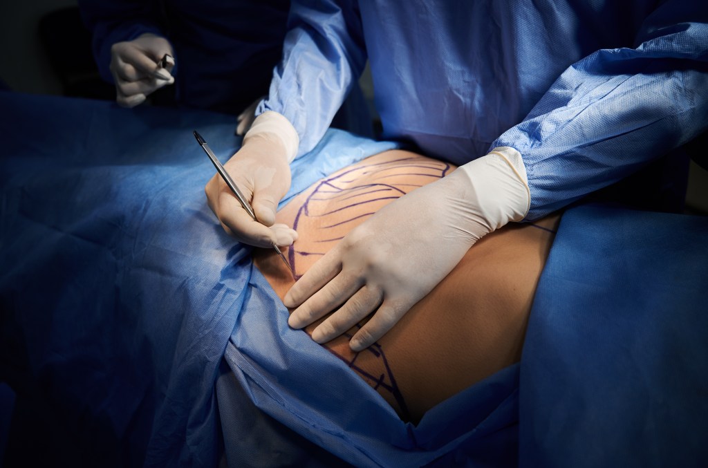 Surgeon's gloved hands making an incision with a scalpel on a patient's abdomen marked for plastic surgery.