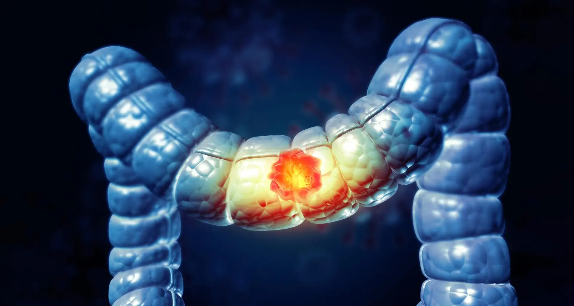 Most Americans don’t know this food raises colon cancer risk