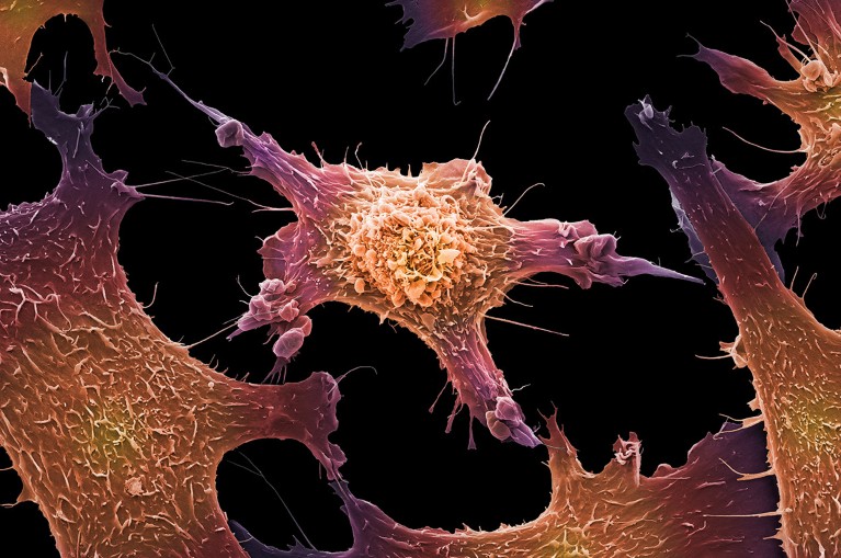 A coloured scanning electron micrograph of the lumpy, distorted surface of a clump of breast cancer cells.