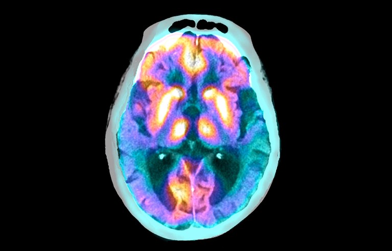 Coloured image combining PET and CT scans of the brain of a woman with Alzheimer's disease.