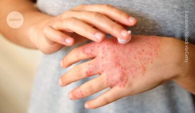 Stress can cause eczema to flare-up – now we know why