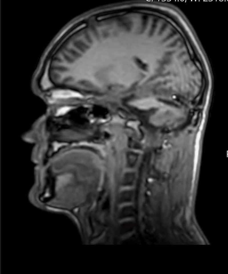 Luke Taylor's brain scanCredit: Nia Jones via SWNS
