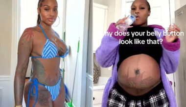 Woman, 34, Got a Tummy Tuck After Having 3 Kids. She Was Shocked by How the Plastic Surgery Affected Her 4th Pregnancy (Exclusive)