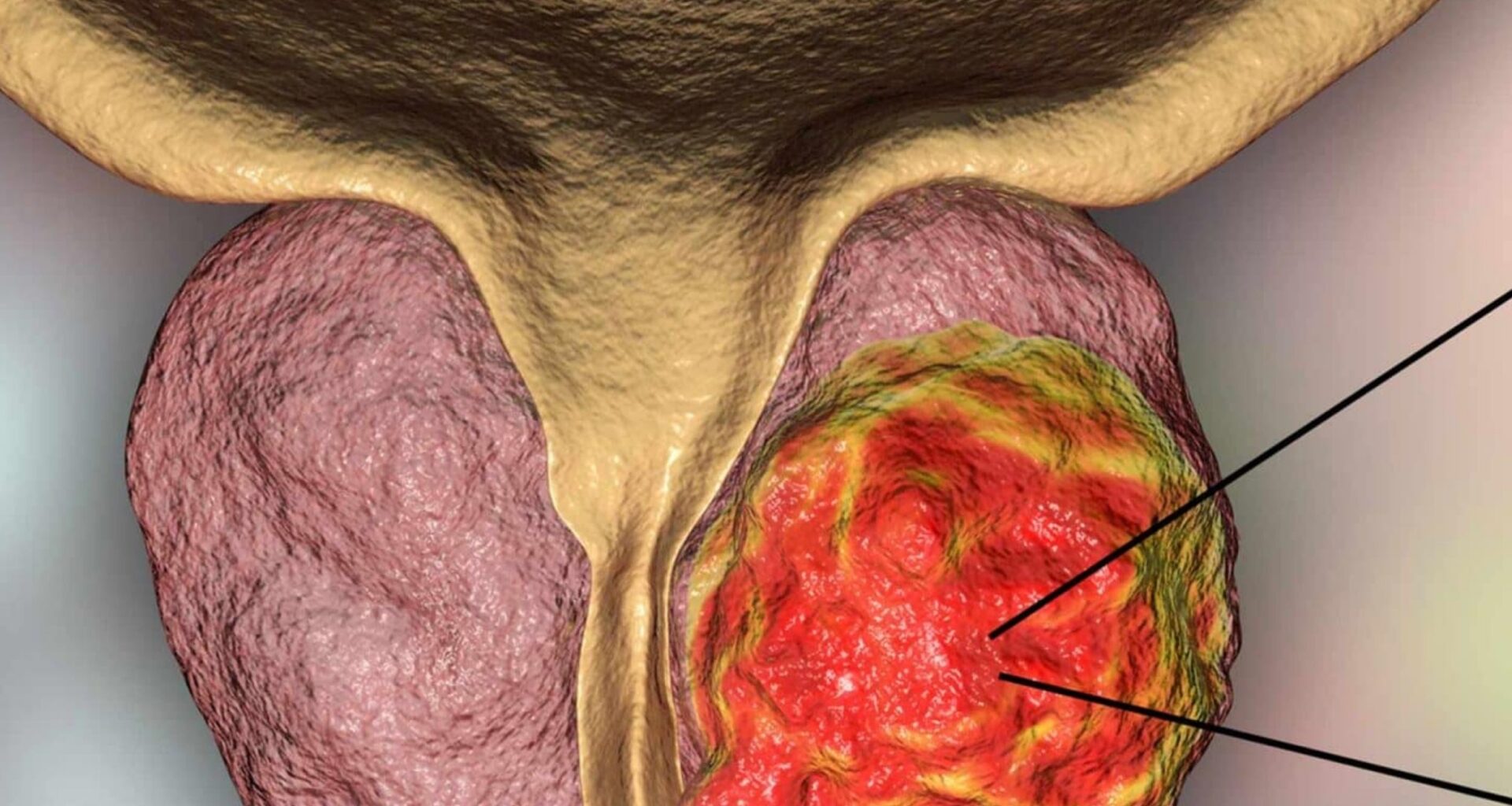 Frequent ejaculation is associated with lower risk of prostate cancer