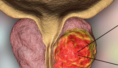 Frequent ejaculation is associated with lower risk of prostate cancer