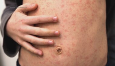 Health officials warn of possible measles exposure in Guilford County