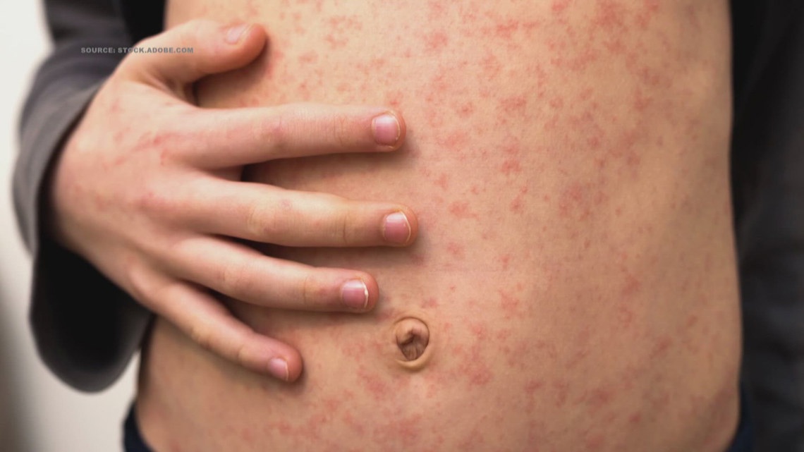 Health officials warn of possible measles exposure in Guilford County