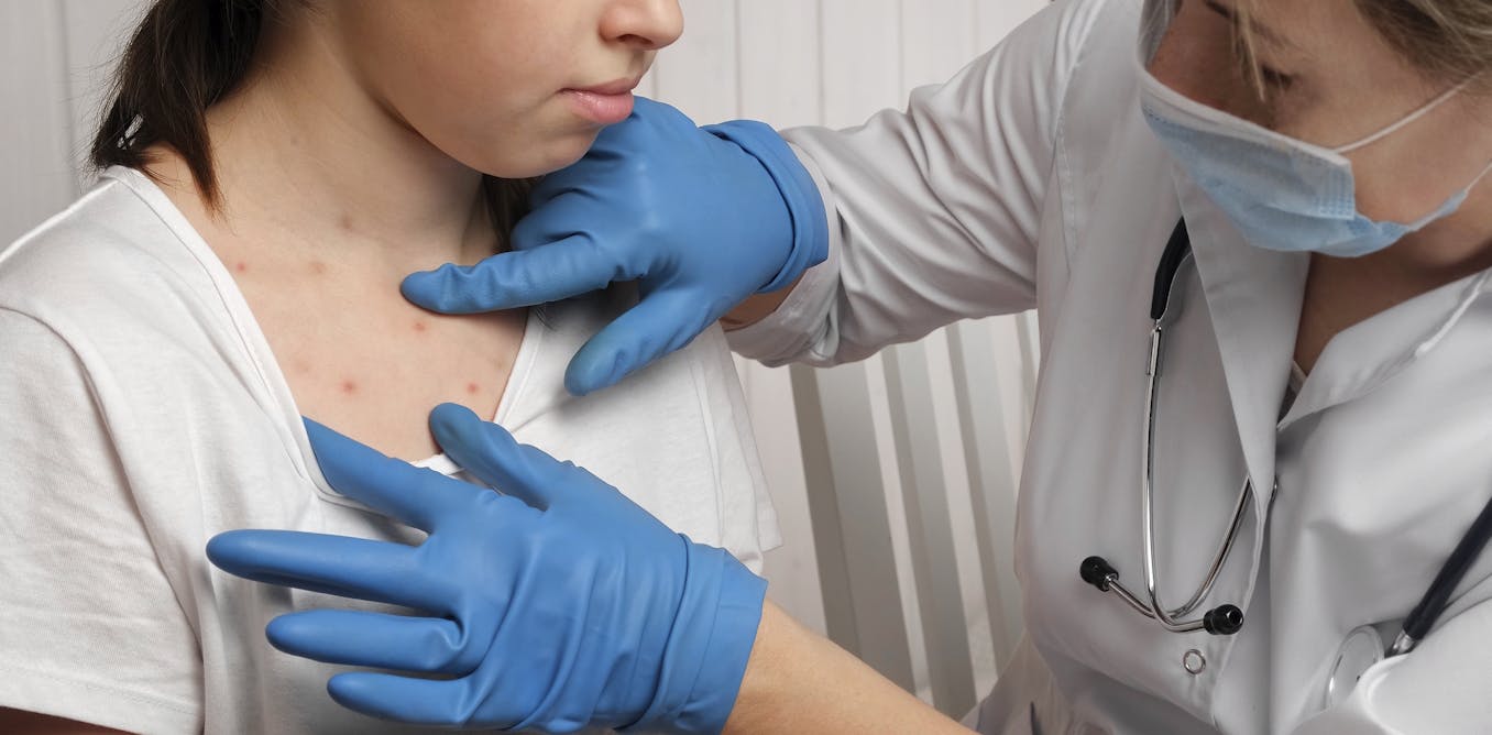 We study pandemics, and the resurgence of measles is a grim sign of what’s coming