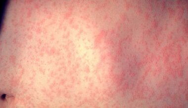 Kansas City health officials confirm first measles case in eight years