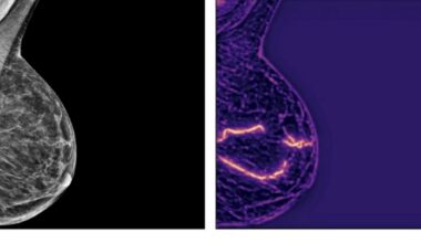 Significant Heart Disease Risk Can Be Detected from Routine Mammograms Using AI – Up to 70% Greater