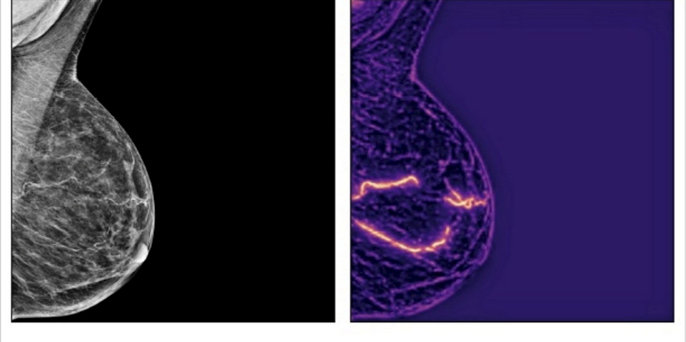 Significant Heart Disease Risk Can Be Detected from Routine Mammograms Using AI – Up to 70% Greater