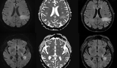 You're likely already infected with a brain-eating virus you've never heard of