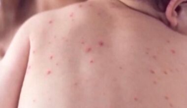 Health chief's concerning three-word message as world's most infectious disease rips across CA