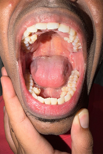 Prathab showing off his extra teeth