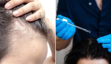 Triple threat fights hair loss better than finasteride and minoxidil